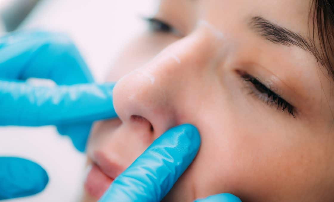 tout savoir sur rhinoplastie